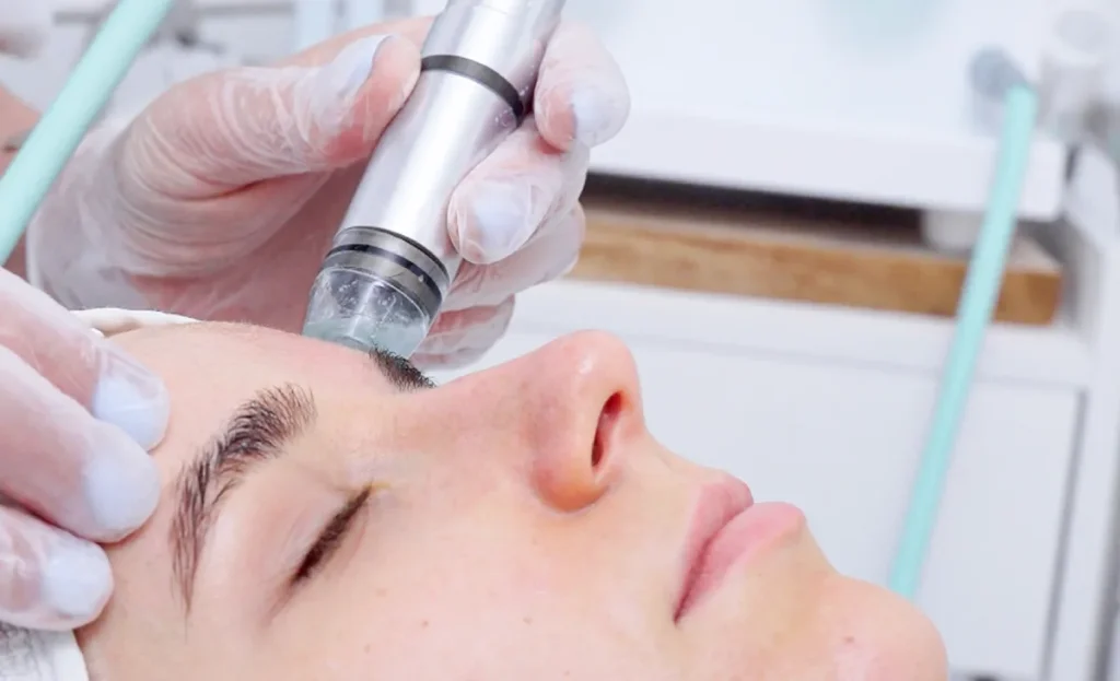 Microdermabrasion facial Queens NY